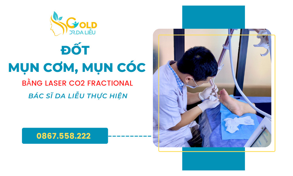 mụn cơm mụn cóc