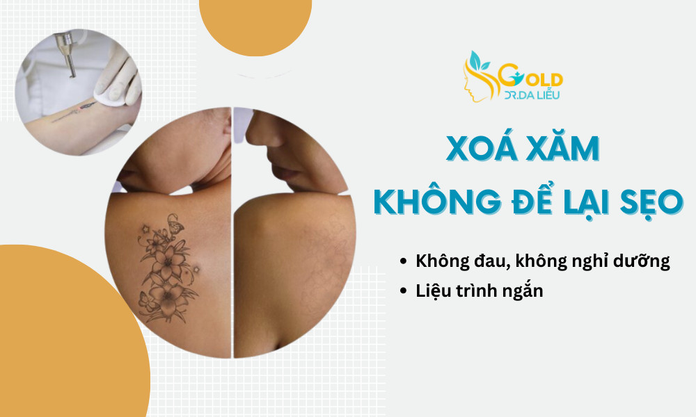 Xoá xăm 10-20 cm2 ( 3 buổi ) 
